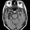 1A1 Pick Disease (Case 1) T1 1 - Copy