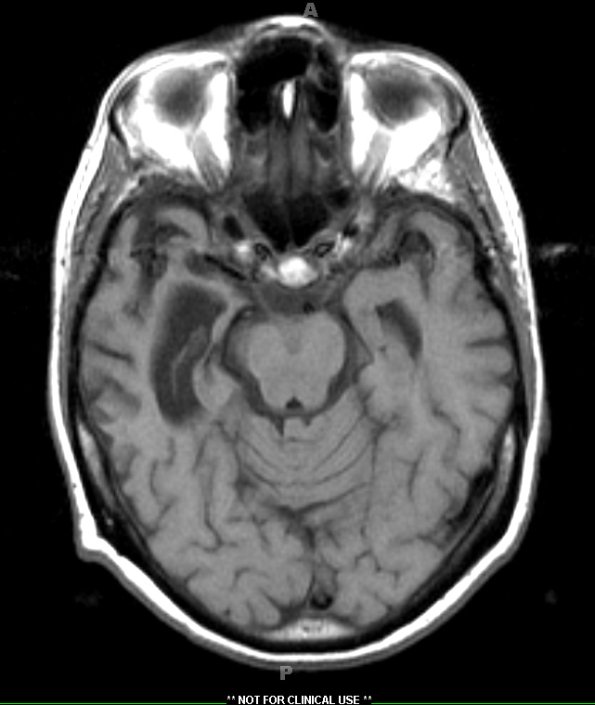 1A1 Pick Disease (Case 1) T1 1 - Copy