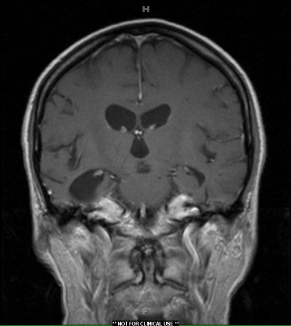 1A2 Pick Disease (Case 1) T1W 1 - Copy