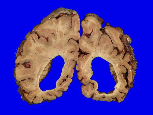 1B10 Pick Disease (Case 1) 12