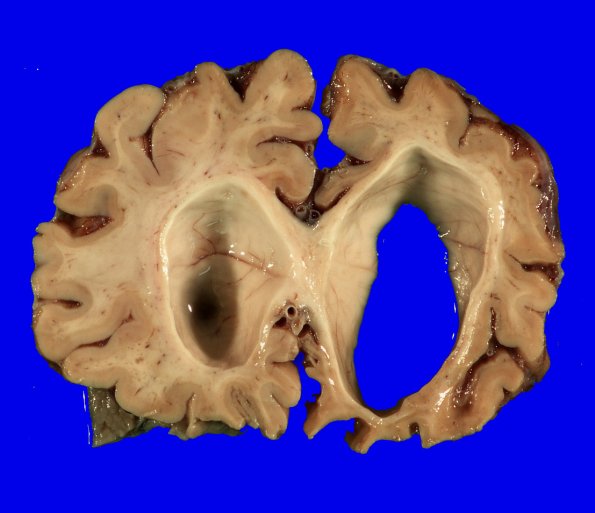 1B2 Pick Disease (Case 1) 6