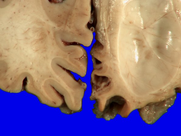 1B3 Pick Disease (Case 1) 19