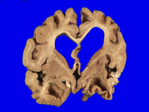 1B5 Pick Disease (Case 1) 8