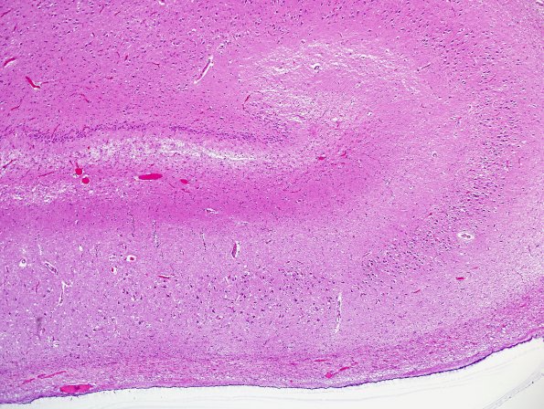 1C2 Pick Disease (Case 1) L5 HC H&E 1.jpg