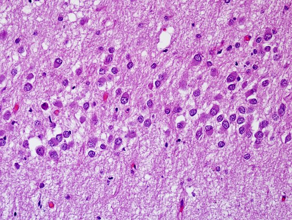 1C3 Pick Disease (Case 1) L5 HC H&E 5.jpg