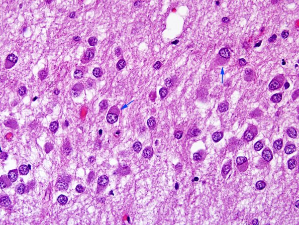 1C4 Pick Disease (Case 1) L5 HC H&E 3 copy.jpg