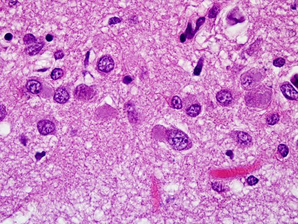 1C5 Pick Disease (Case 1) L5 Dentate 100X H&E 3.jpg