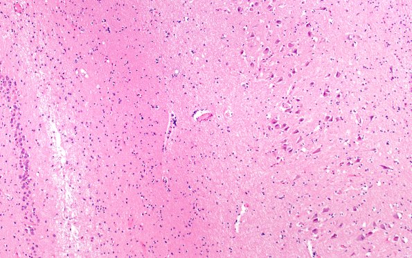 1C6 Pick Disease (Case 1) L5 CA1 60X A