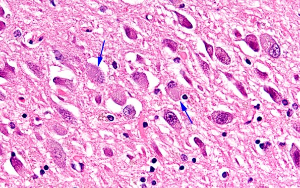 1C7 Pick Disease (Case 1) L5 CA1 60X copy