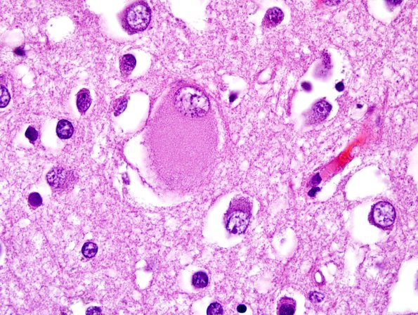 1D10 Pick Disease (Case 1) L19 H&E 100X 1.jpg