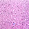 1D2 Pick Disease (Case 1) L19 cingulate H&E 10X 2 copy