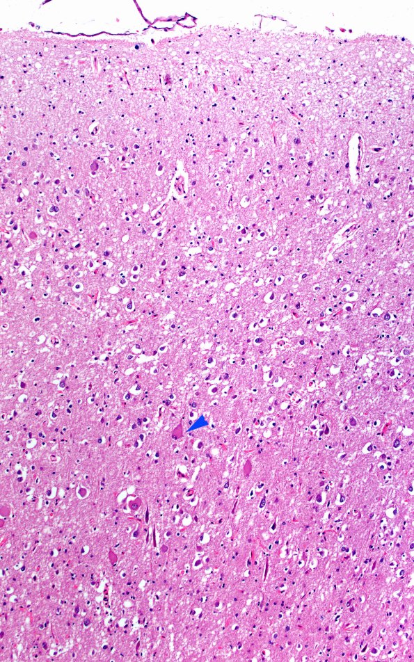 1D2 Pick Disease (Case 1) L19 cingulate H&E 10X 2 copy