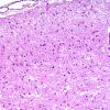 1D3 Pick Disease (Case 1) L19 H&E 17.jpg