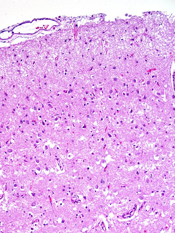 1D3 Pick Disease (Case 1) L19 H&E 17.jpg