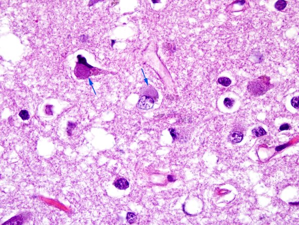 1D4 Pick Disease (Case 1) L19 H&E 100X 4 copy.jpg