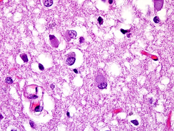 1D5 Pick Disease (Case 1) L19 H&E 10.jpg