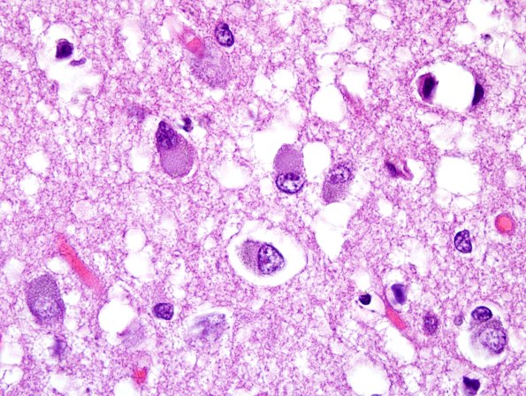 1D6 Pick Disease (Case 1) L19 H&E 100X 7.jpg