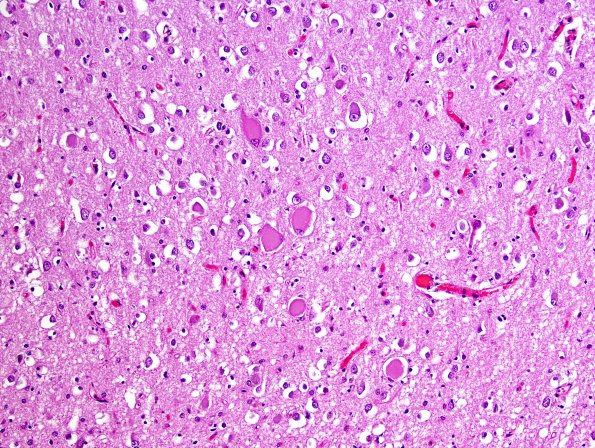 1D7 Pick Disease (Case 1) L19 H&E 9.jpg