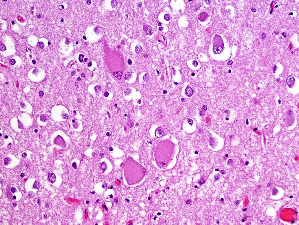 1D8 Pick Disease (Case 1) L19 H&E 7.jpg