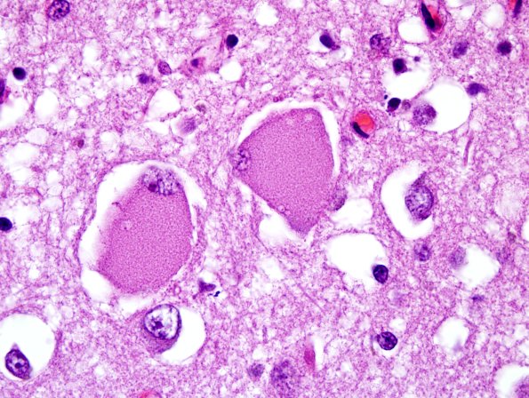 1D9 Pick Disease (Case 1) L19 H&E 100X 2.jpg