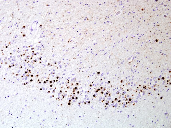 1E3 Pick Disease (Case 1) L5 HC PHF1 3.jpg