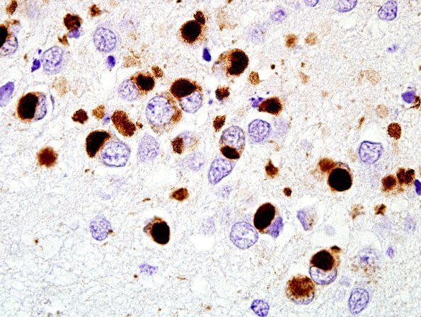 1E4 Pick Disease (Case 1) L5 Dentate 100X PHF1 1.jpg