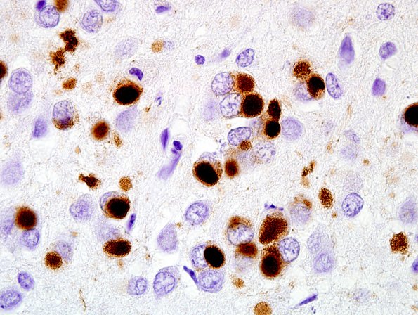 1E5 Pick Disease (Case 1) L5 Dentate 100X PHF1 4.jpg