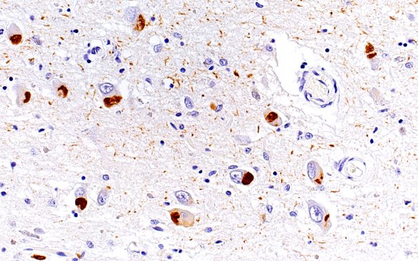 1E6 Pick Disease (Case 1) L5 HC PHF1 10X