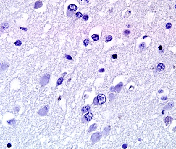 1E7 Pick Disease (Case 1) L19 pSYN 1.jpg