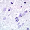 1E8 Pick Disease (Case 1) L19 pSYN 100X 3.jpg