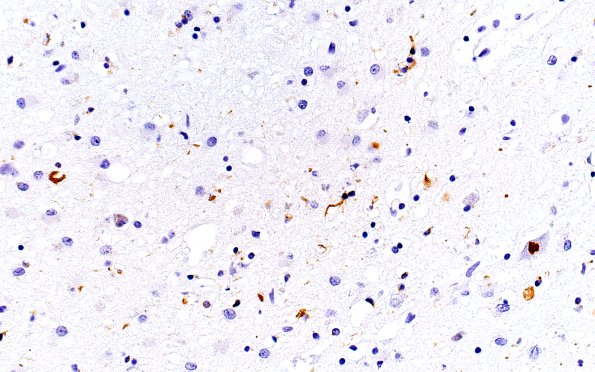 1E9 Pick Disease, coiled bodies (Case 1) L5 PHF1 40X