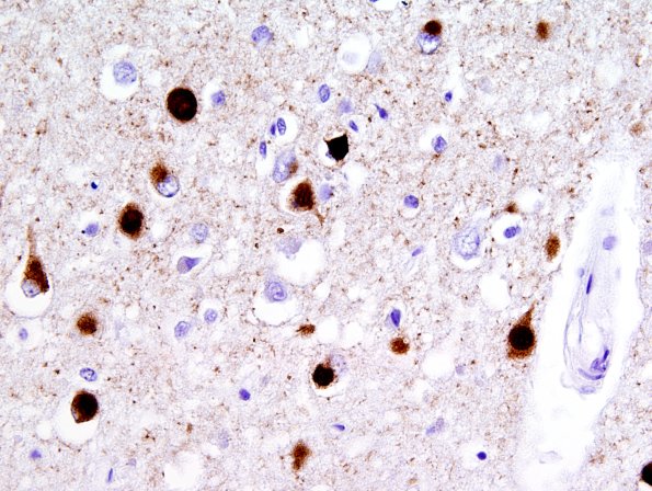 1F10 Pick Disease (Case 1) L19 PHF1 5.jpg