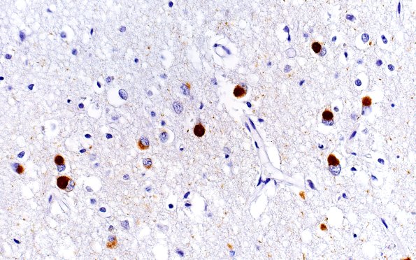 1F11 Pick Disease (Case 1) L19 PHf1 40X