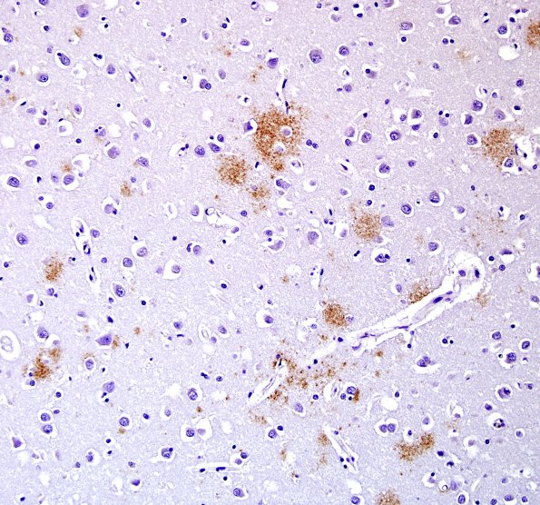 1F12 Pick Disease (Case 1) N1 BAmyloid 20X.jpg