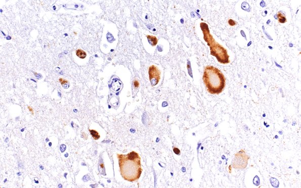 1F2 Pick Disease (Case 1)  PHF1 40X