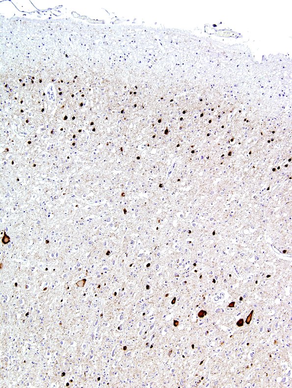 1F3 Pick Disease (Case 1) L19 PHF1 4