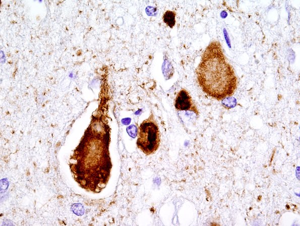 1F5 Pick Disease (Case 1) L19 PHF1 100X 6.jpg