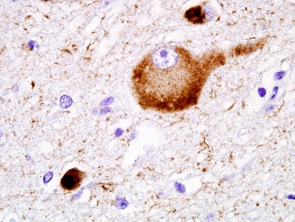 1F7 Pick Disease (Case 1) L19 PHF1 100X 7.jpg