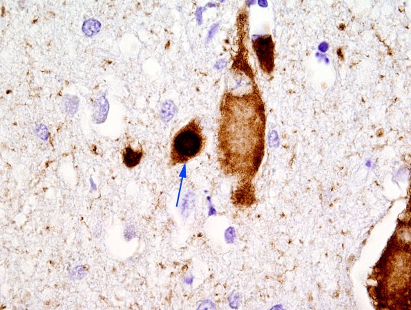 1F8 Pick Disease (Case 1) L19 PHF1 100X 5 copy.jpg