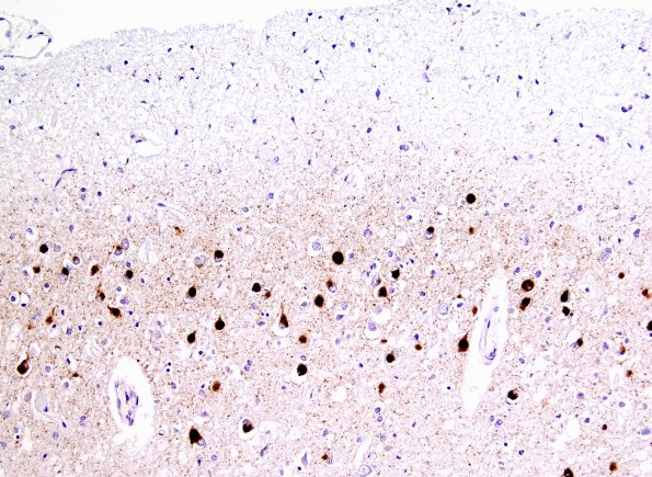 1F9 Pick Disease (Case 1) L19 PHF1 7.jpg