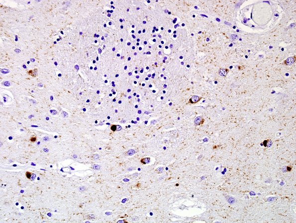 1G2 Pick Disease (Case 1) L6 BG PHF1 2.jpg