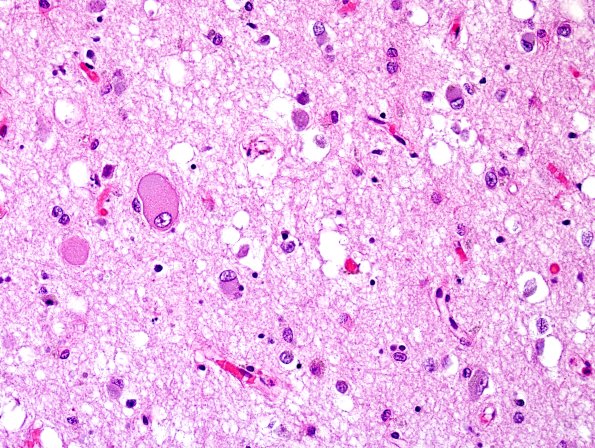 1G3 Pick Disease (Case 1) L5 nBM H&E 1.jpg