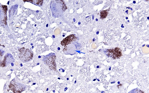 1G8 SYN Pick Disease (Case 1)  Pons LC pSYN 60X copy