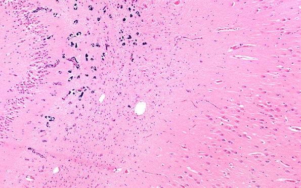 2B3 Pick Dz (Case 2) N3 H&E 10X