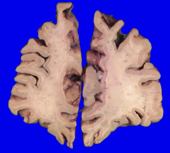 3A5 Pick Dz (Case 3) Gross _5