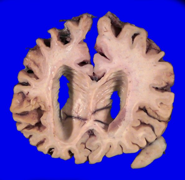 3A6 Pick Dz (Case 3) Gross _6