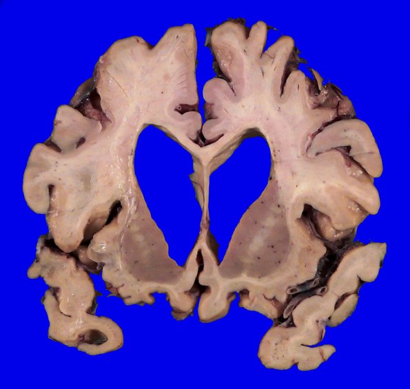 3A7 Pick Dz (Case 3) Gross _7