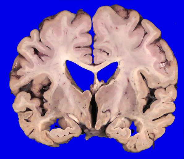 3A8 Pick Dz (Case 3) Gross _8