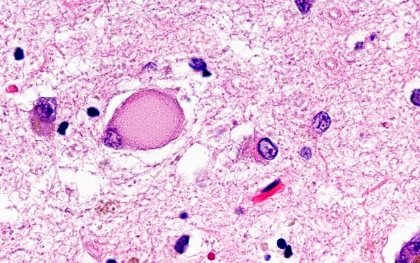 3B8 Pick Dz (Case 3) N1 H&E 100X