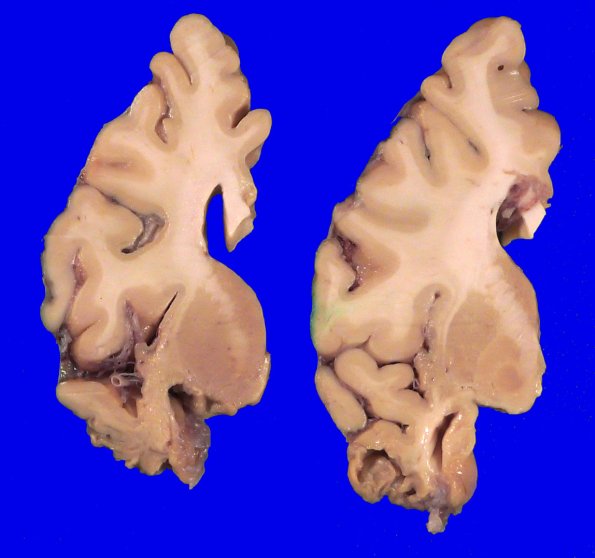 5A3 Pick Dz (Case 5) _3